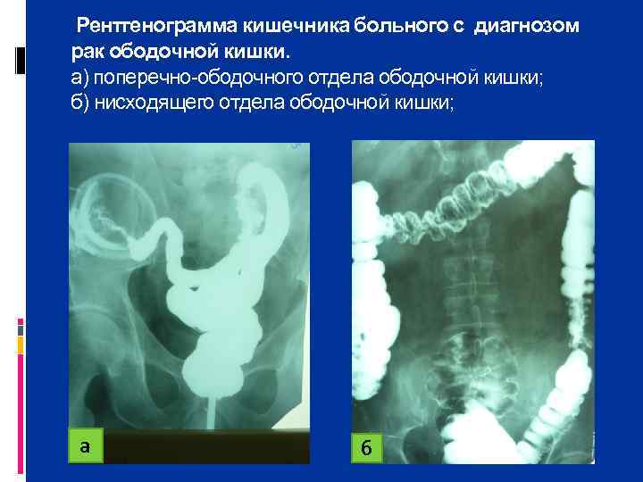  Рентгенограмма кишечника больного с диагнозом рак ободочной кишки. а) поперечно ободочного отдела ободочной