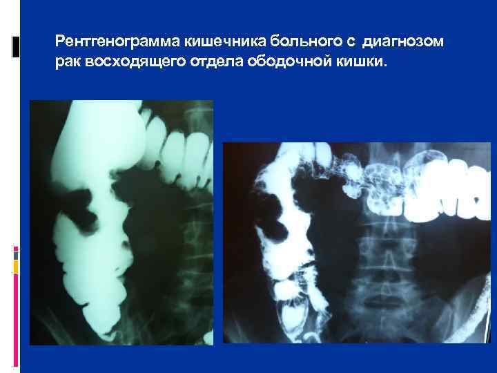 Рентгенограмма кишечника больного с диагнозом рак восходящего отдела ободочной кишки. 