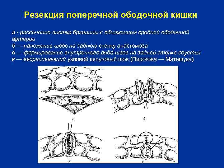   Резекция поперечной ободочной кишки а - рассечение листка брюшины с обнажением средней