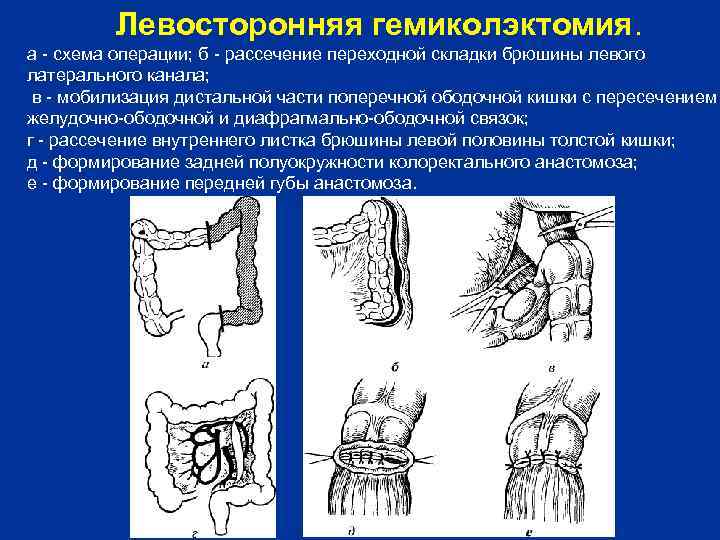    Левосторонняя гемиколэктомия. а  схема операции; б  рассечение переходной складки