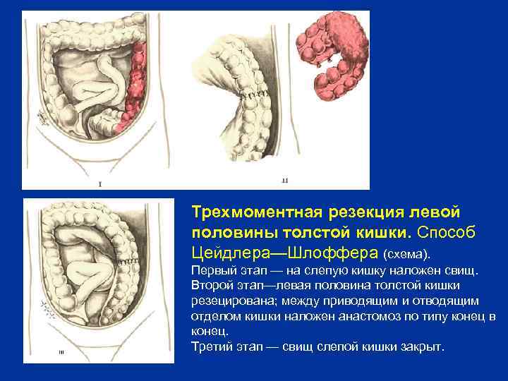 Трехмоментная резекция левой половины толстой кишки. Способ Цейдлера—Шлоффера (схема). Первый этап — на слепую