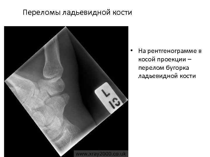 Переломы ладьевидной кости • На рентгенограмме в косой проекции – перелом бугорка ладьевидной кости