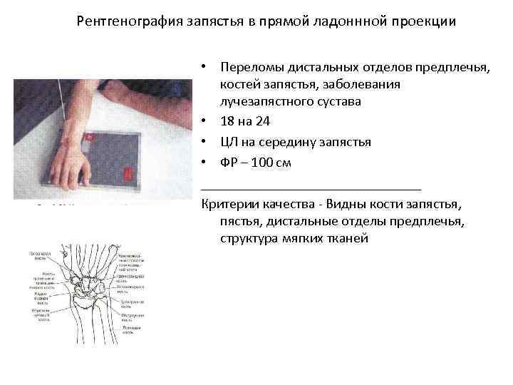 Рентгенография запястья в прямой ладоннной проекции • Переломы дистальных отделов предплечья, костей запястья, заболевания