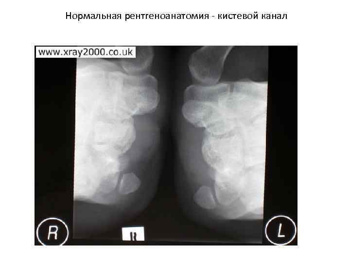 Нормальная рентгеноанатомия кистевой канал 