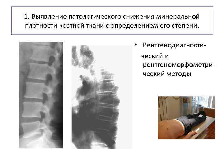 1. Выявление патологического снижения минеральной плотности костной ткани с определением его степени. • Рентгенодиагностический
