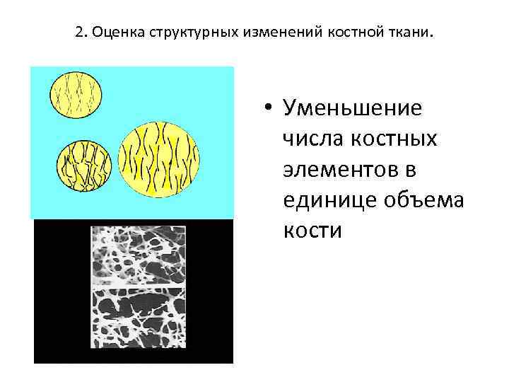 2. Оценка структурных изменений костной ткани. • Уменьшение числа костных элементов в единице объема