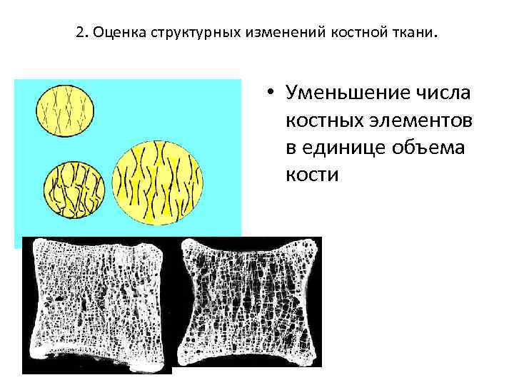 2. Оценка структурных изменений костной ткани. • Уменьшение числа костных элементов в единице объема
