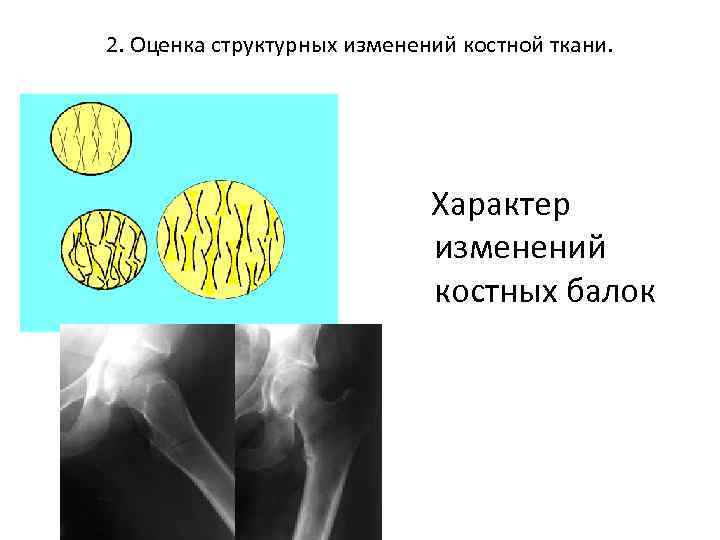 2. Оценка структурных изменений костной ткани. Характер изменений костных балок 