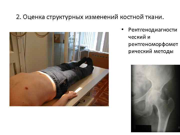 2. Оценка структурных изменений костной ткани. • Рентгенодиагности ческий и рентгеноморфомет рический методы 