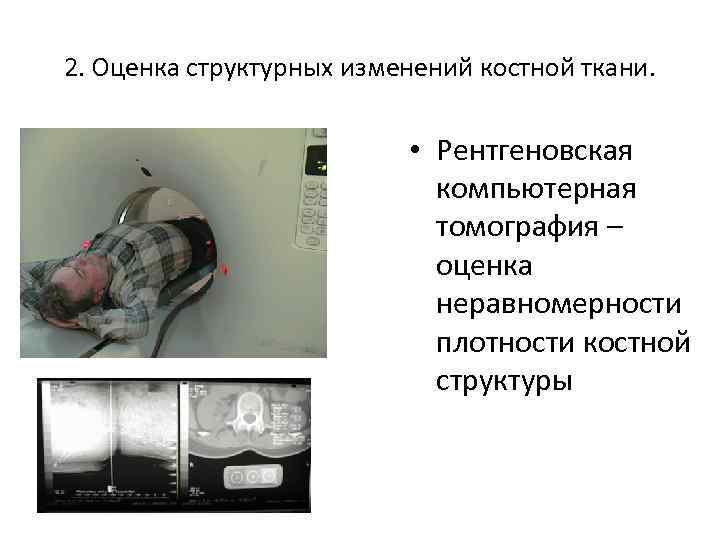 2. Оценка структурных изменений костной ткани. • Рентгеновская компьютерная томография – оценка неравномерности плотности