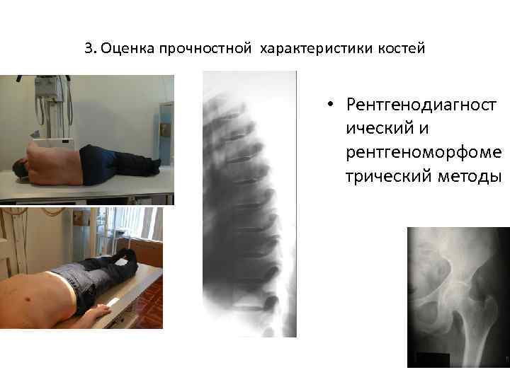3. Оценка прочностной характеристики костей • Рентгенодиагност ический и рентгеноморфоме трический методы 
