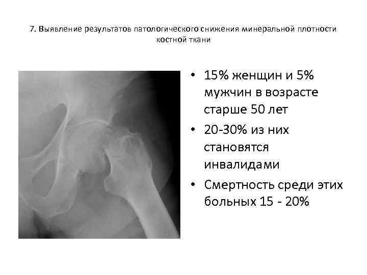 7. Выявление результатов патологического снижения минеральной плотности костной ткани • 15% женщин и 5%