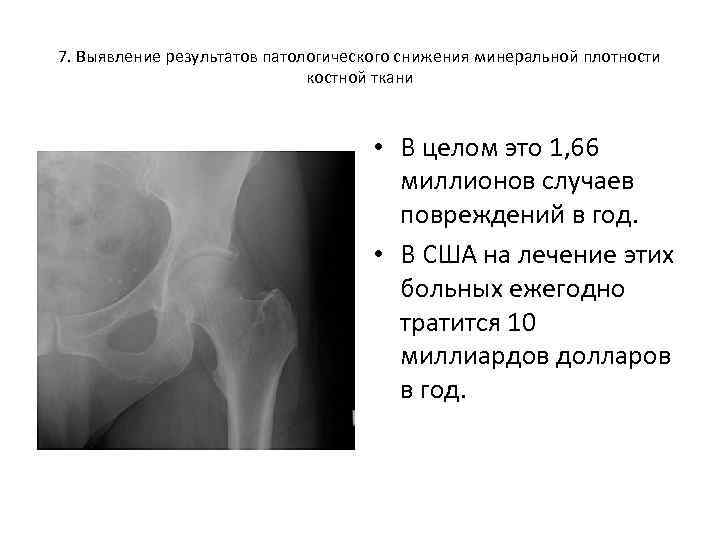 7. Выявление результатов патологического снижения минеральной плотности костной ткани • В целом это 1,