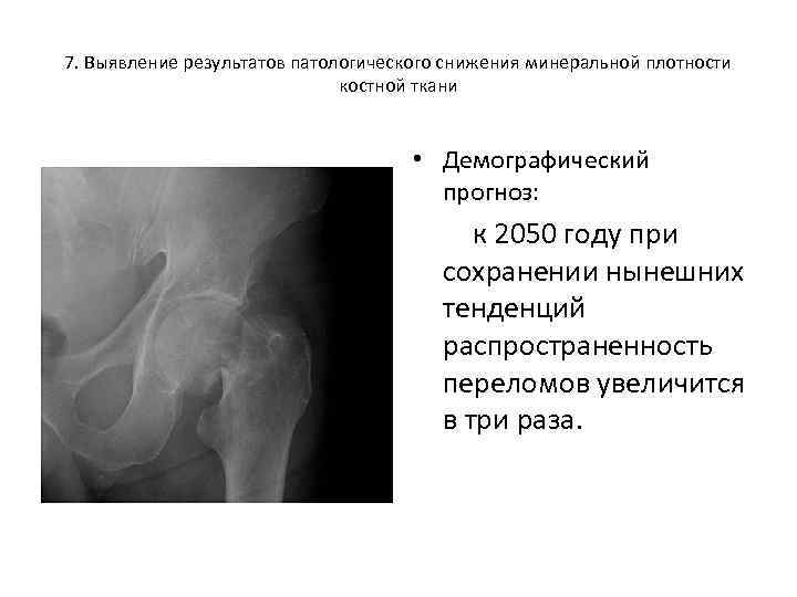 7. Выявление результатов патологического снижения минеральной плотности костной ткани • Демографический прогноз: к 2050
