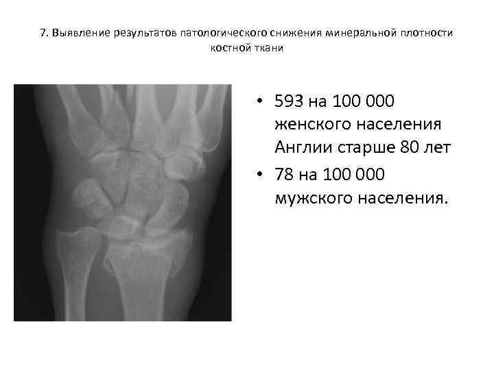 7. Выявление результатов патологического снижения минеральной плотности костной ткани • 593 на 100 000