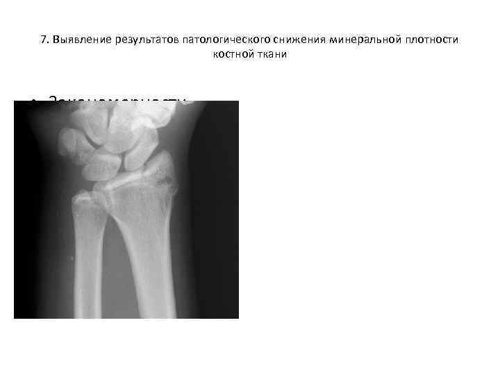 7. Выявление результатов патологического снижения минеральной плотности костной ткани • Закономерности распространенности такие же,