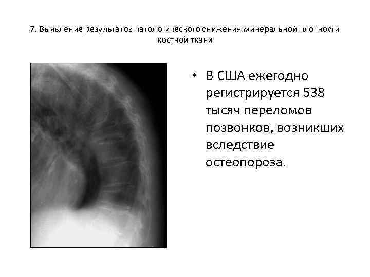 7. Выявление результатов патологического снижения минеральной плотности костной ткани • В США ежегодно регистрируется