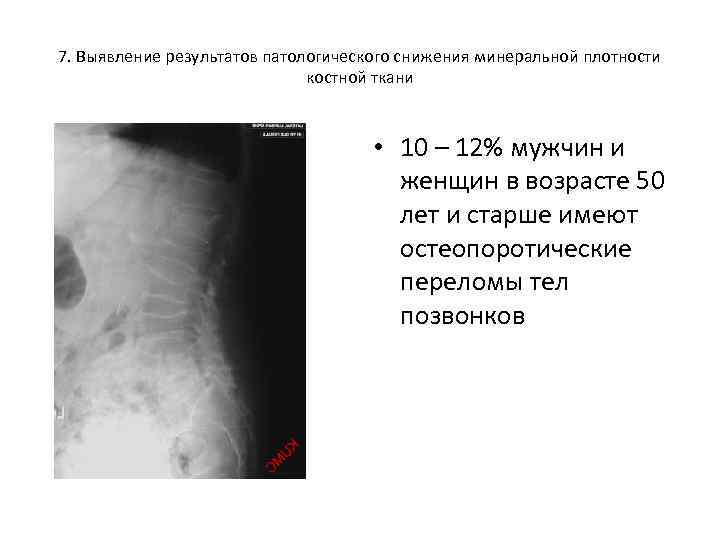 7. Выявление результатов патологического снижения минеральной плотности костной ткани • 10 – 12% мужчин