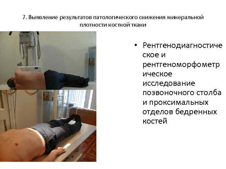7. Выявление результатов патологического снижения минеральной плотности костной ткани • Рентгенодиагностиче ское и рентгеноморфометр