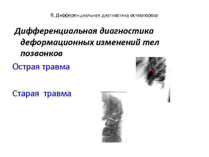 9. Дифференциальная диагностика остеопороза Дифференциальная диагностика деформационных изменений тел позвонков Острая травма Старая травма