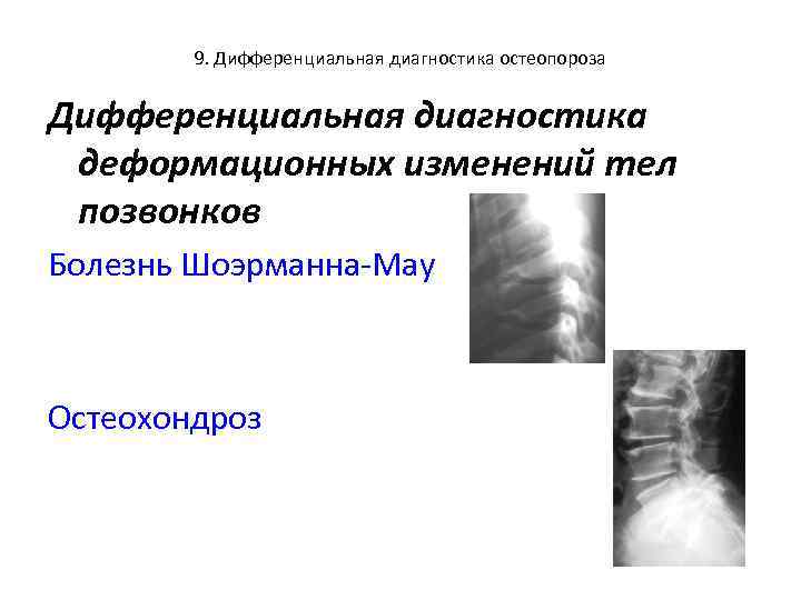 9. Дифференциальная диагностика остеопороза Дифференциальная диагностика деформационных изменений тел позвонков Болезнь Шоэрманна-Мау Остеохондроз 