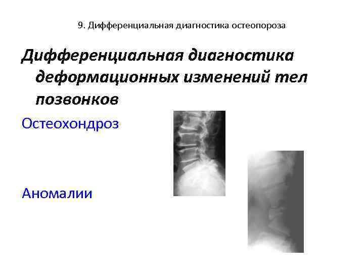 9. Дифференциальная диагностика остеопороза Дифференциальная диагностика деформационных изменений тел позвонков Остеохондроз Аномалии 