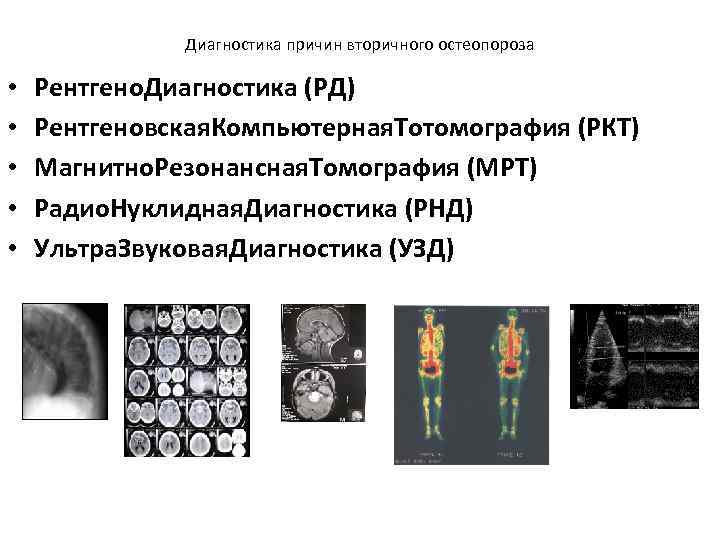 Диагностика причин вторичного остеопороза • • • Рентгено. Диагностика (РД) Рентгеновская. Компьютерная. Тотомография (РКТ)