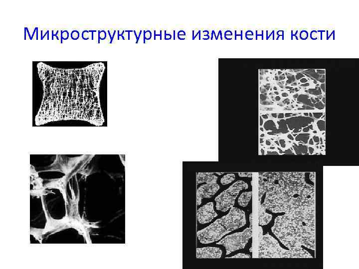 Микроструктурные изменения кости 