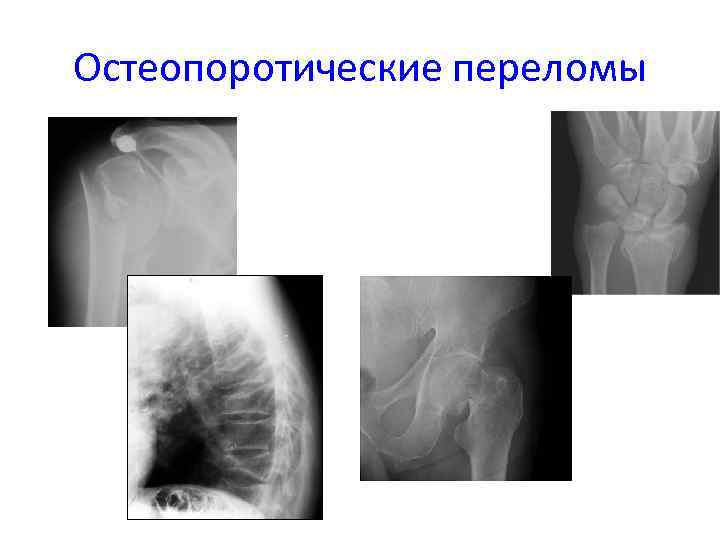 Остеопоротические переломы 