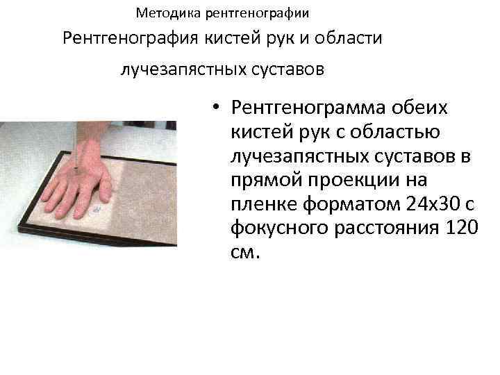  Методика рентгенографии Рентгенография кистей рук и области лучезапястных суставов • Рентгенограмма обеих кистей
