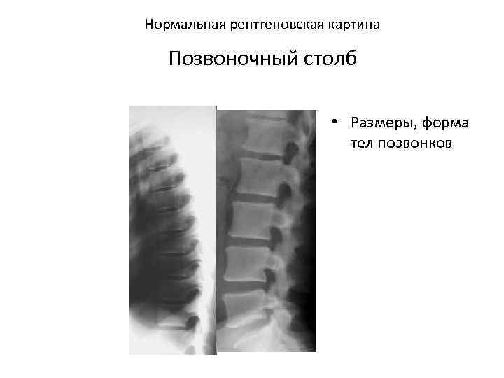 Нормальная рентгеновская картина Позвоночный столб • Размеры, форма тел позвонков 