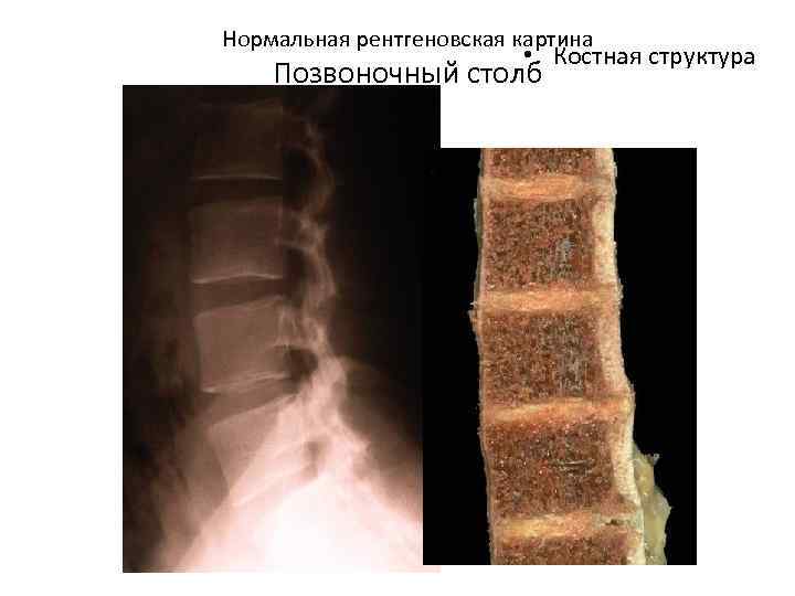 Нормальная рентгеновская картина • Костная структура Позвоночный столб 