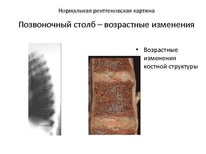  Нормальная рентгеновская картина Позвоночный столб – возрастные изменения • Возрастные изменения костной структуры