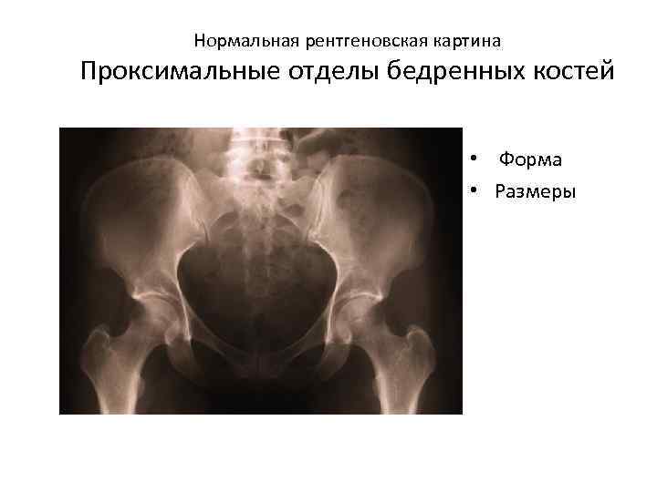 Нормальная рентгеновская картина Проксимальные отделы бедренных костей • Форма • Размеры 