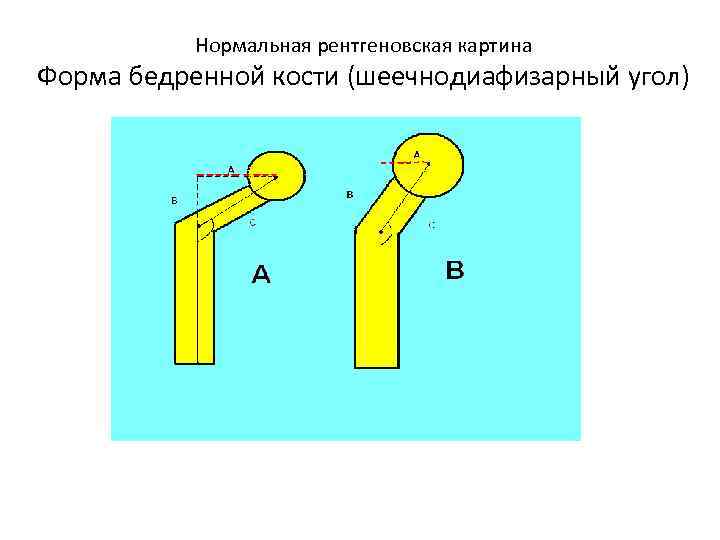  Нормальная рентгеновская картина Форма бедренной кости (шеечнодиафизарный угол) 