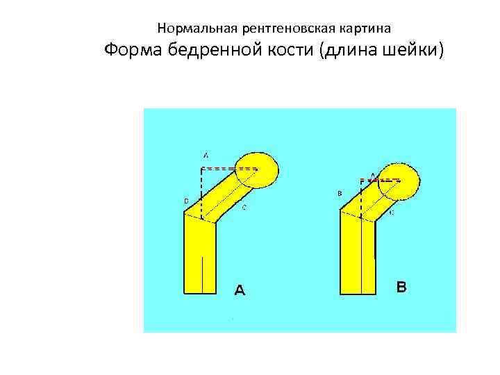  Нормальная рентгеновская картина Форма бедренной кости (длина шейки) 