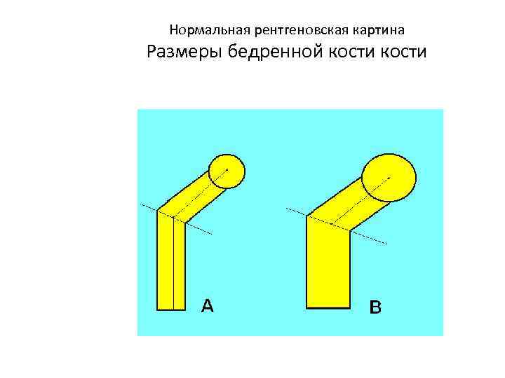  Нормальная рентгеновская картина Размеры бедренной кости 