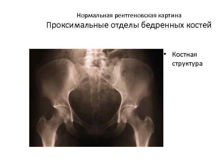  Нормальная рентгеновская картина Проксимальные отделы бедренных костей • Костная структура 