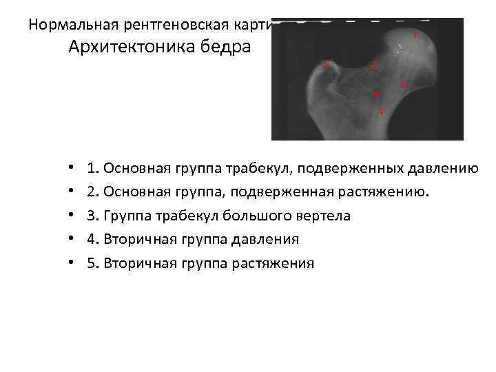 Нормальная рентгеновская картина 1 Архитектоника бедра 3 2 5 w 4 • 1. Основная