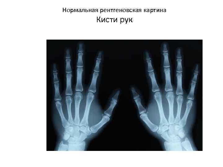 Нормальная рентгеновская картина Кисти рук 