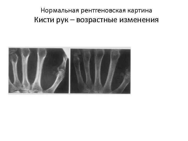  Нормальная рентгеновская картина Кисти рук – возрастные изменения 