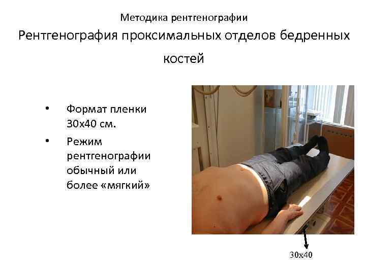  Методика рентгенографии Рентгенография проксимальных отделов бедренных костей • Формат пленки 30 х40 см.