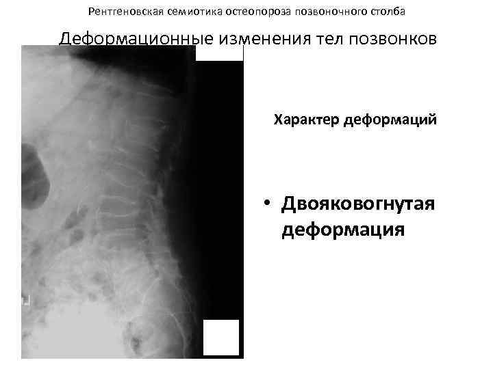 Рентгеновская семиотика остеопороза позвоночного столба Деформационные изменения тел позвонков Характер деформаций • Двояковогнутая деформация