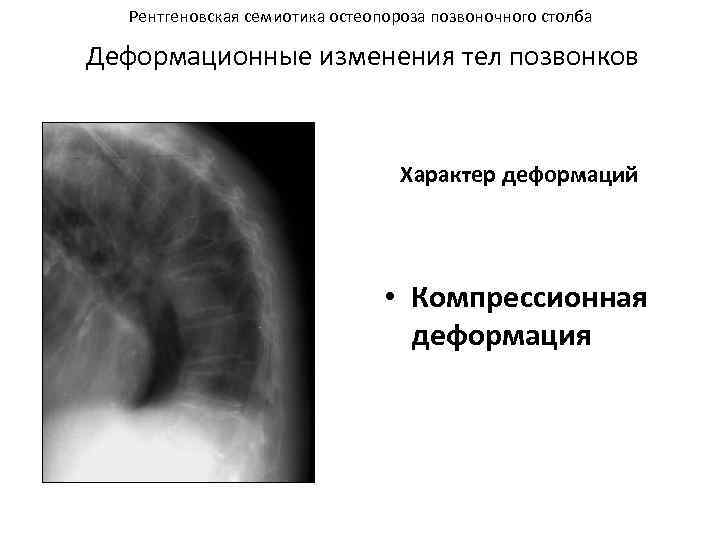 Рентгеновская семиотика остеопороза позвоночного столба Деформационные изменения тел позвонков Характер деформаций • Компрессионная деформация