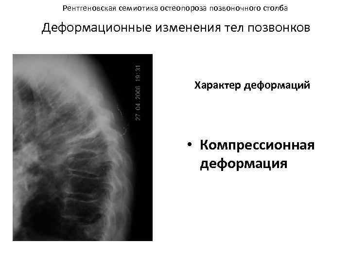 Рентгеновская семиотика остеопороза позвоночного столба Деформационные изменения тел позвонков Характер деформаций • Компрессионная деформация