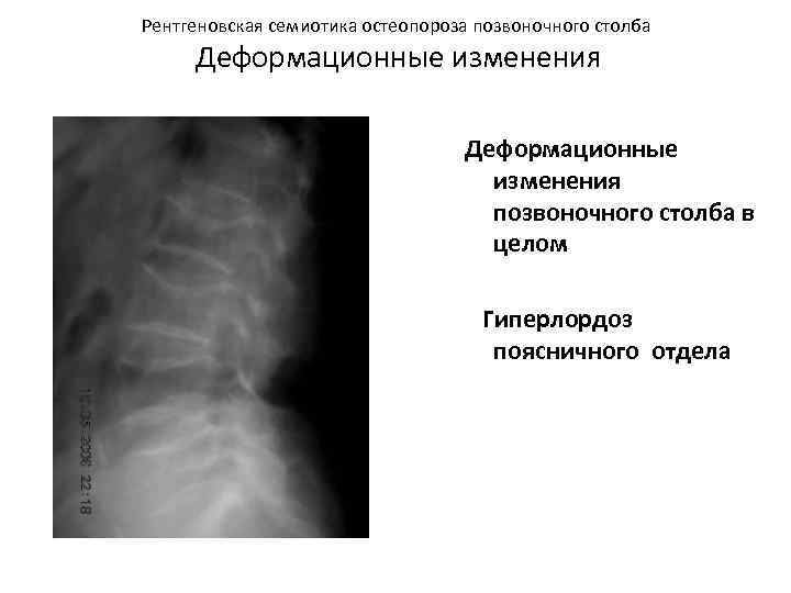 Рентгеновская семиотика остеопороза позвоночного столба Деформационные изменения позвоночного столба в целом Гиперлордоз поясничного отдела