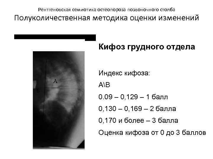 1 рентген. Кифоз рентген степени по коббу. Кифоз рентген по коббу. Угол грудного кифоза норма. Патологический кифоз рентген.