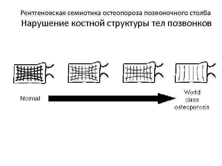 Рентгеновская семиотика остеопороза позвоночного столба Нарушение костной структуры тел позвонков 