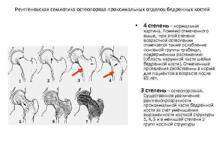 Перелом бедренной кости клинические рекомендации тесты нмо. Остеопороз классификация рентген. Остеопороз головки бедренной кости. Рентгеноденситометрия проксимального отдела бедренной кости. Проксимальный отдел бедренной кости.