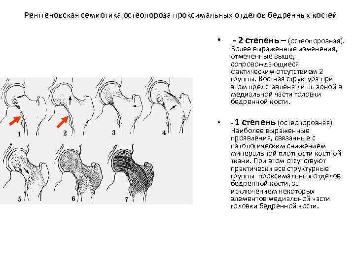 Рентгеновская семиотика остеопороза проксимальных отделов бедренных костей • • - 2 степень – (остеопорозная).